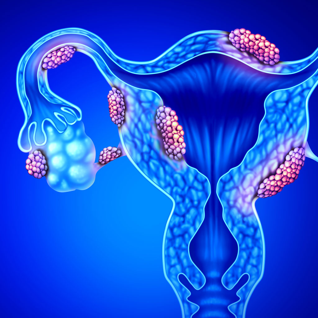 Fibroid Illustration