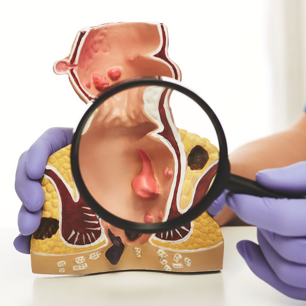 Hemorrhoid Artery Embolization Model