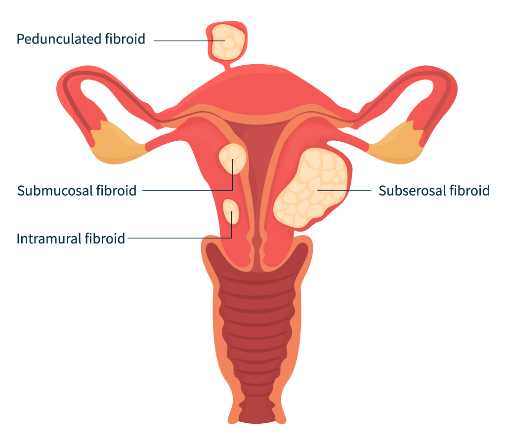 types of fibroids