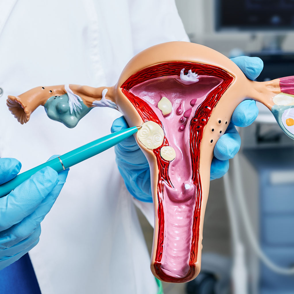 How UFE Treats Fibroids Doctor Holding Uterus Model