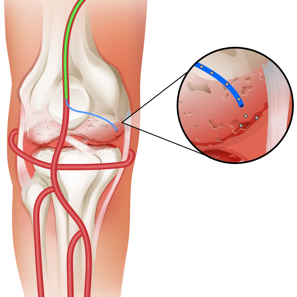 genicular artery embolization
