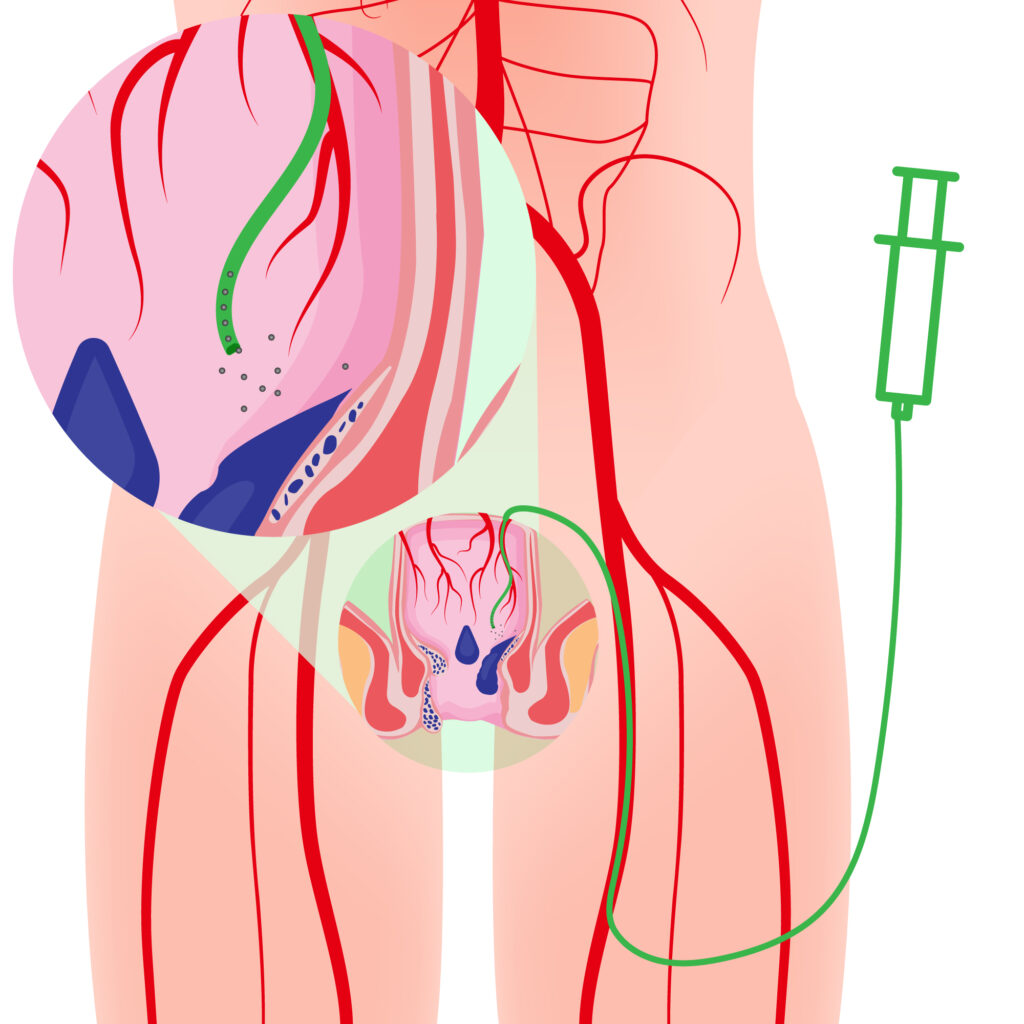 HAE procedure