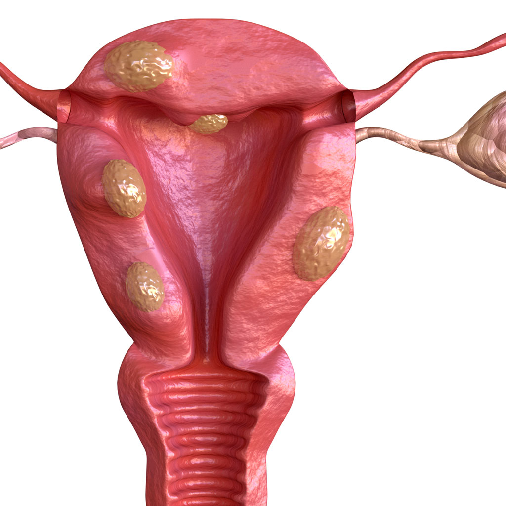 Uterine Fibroids Render Fibroid Facts