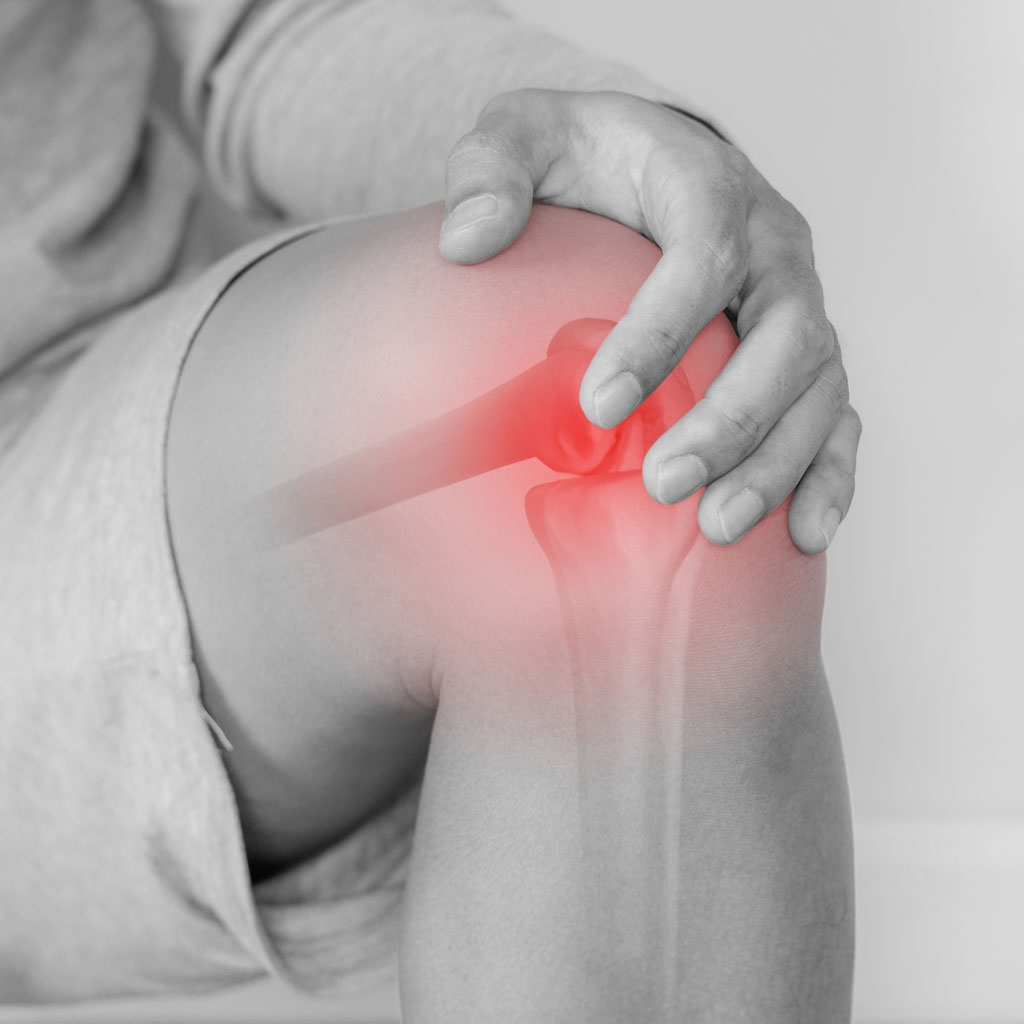 Knee Showing Signs of Knee Osteoarthritis